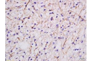 Formalin-fixed and paraffin embedded human glioma labeled with Rabbit Anti-MDGA2 Polyclonal Antibody, Unconjugated  at 1:200 followed by conjugation to the secondary antibody and DAB staining (MDGA2 抗体  (AA 751-850))