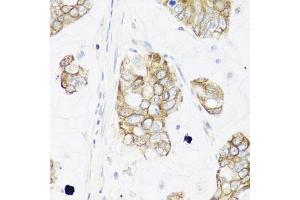 Immunohistochemistry of paraffin-embedded human gastric cancer using IER3 antibody (ABIN6134174, ABIN6142158, ABIN6142159 and ABIN6224665) at dilution of 1:100 (40x lens). (IER3 抗体  (C-Term))