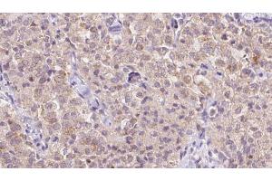 ABIN6273349 at 1/100 staining Human thyroid cancer tissue by IHC-P. (WSB1 抗体  (Internal Region))