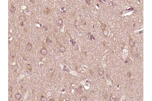 Paraformaldehyde-fixed, paraffin embedded human glioma, Antigen retrieval by boiling in sodium citrate buffer (pH6) for 15min, Block endogenous peroxidase by 3% hydrogen peroxide for 30 minutes,  Blocking buffer (normal goat serum) at 37°C for 20min, Antibody incubation with PTPN6(Tyr536) Polyclonal Antibody (bs-5577R) at 1:400 overnight at 4°C, followed by a conjugated secondary and DAB staining. (SHP1 抗体  (pTyr536))