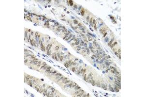 Immunohistochemistry of paraffin-embedded human colon carcinoma using TIA1 antibody (ABIN6293426) at dilution of 1:100 (40x lens). (TIA1 抗体)