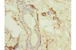 Immunohistochemistry of paraffin-embedded human breast cancer using ABIN7172975 at dilution of 1:100 (TMED2 抗体  (AA 26-111))