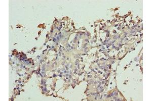 Immunohistochemistry of paraffin-embedded human breast cancer using ABIN7171951 at dilution of 1:100 (TTC9C 抗体  (AA 1-171))