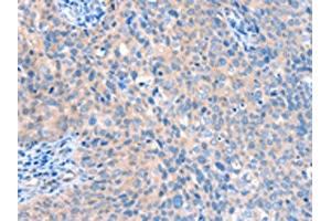 The image on the left is immunohistochemistry of paraffin-embedded Human cervical cancer tissue using ABIN7128170(ACOX1 Antibody) at dilution 1/20, on the right is treated with fusion protein. (ACOX1 抗体)