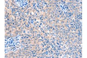 The image on the left is immunohistochemistry of paraffin-embedded Human cervical cancer tissue using ABIN7128170(ACOX1 Antibody) at dilution 1/20, on the right is treated with fusion protein. (ACOX1 抗体)