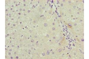 Immunohistochemistry of paraffin-embedded human liver cancer using ABIN7158038 at dilution of 1:100 (LRG1 抗体  (AA 36-346))
