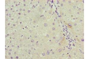Immunohistochemistry of paraffin-embedded human liver cancer using ABIN7158038 at dilution of 1:100