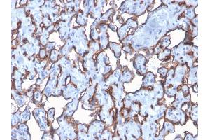 Formalin-fixed, paraffin-embedded human Angiosarcoma stained with CD31 Rabbit Recombinant Monoclonal Antibody (C31/2876R). (Recombinant CD31 抗体)