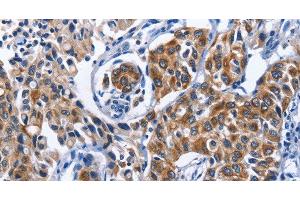 Immunohistochemistry of paraffin-embedded Human lung cancer tissue using MYH1 Polyclonal Antibody at dilution 1:40 (MYH1 抗体)