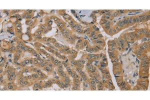 Immunohistochemistry of paraffin-embedded Human thyroid cancer using MVK Polyclonal Antibody at dilution of 1:40 (MVK 抗体)