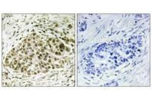 Immunohistochemistry analysis of paraffin-embedded human lung carcinoma tissue, using Lyl-1 antibody. (LYL1 抗体)