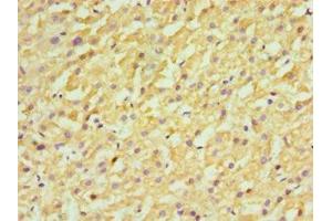 Immunohistochemistry of paraffin-embedded human liver cancer using ABIN7170658 at dilution of 1:100 (FDFT1 抗体  (AA 1-260))