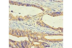 Immunohistochemistry of paraffin-embedded human colon cancer using ABIN7174635 at dilution of 1:100 (UGT2A3 抗体  (AA 201-491))