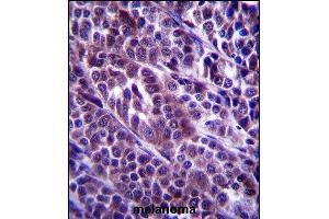 ARMC9 Antibody (N-term) (ABIN657366 and ABIN2846413) immunohistochemistry analysis in formalin fixed and paraffin embedded human melanoma followed by peroxidase conjugation of the secondary antibody and DAB staining. (ARMC9 抗体  (N-Term))