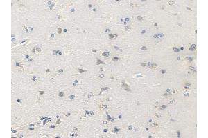 ABIN6256439 and ABIN6267582 at 1/100 staining human glioblastoma by IHC-P.