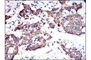Immunohistochemical analysis of paraffin-embedded esophagus cancer tissues using CK5 mouse mAb with DAB staining. (Cytokeratin 5 抗体  (AA 316-590))
