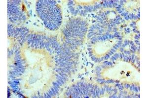 Immunohistochemistry of paraffin-embedded human colon cancer using ABIN7143718 at dilution of 1:100
