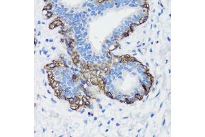 Immunohistochemistry of paraffin-embedded human breast cancer using Filamin A antibody (ABIN7267206) at dilution of 1:100 (40x lens). (Filamin A 抗体  (C-Term))