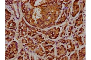 IHC image of ABIN7144072 diluted at 1:348 and staining in paraffin-embedded human pancreatic cancer performed on a Leica BondTM system. (ANAPC2 抗体  (AA 1-230))