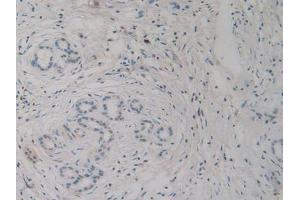IHC-P analysis of Human Pancreas Cancer Tissue, with DAB staining. (H2AFY 抗体  (AA 109-369))