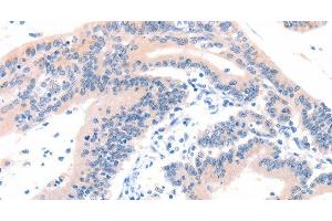 Immunohistochemistry of paraffin-embedded Human colon cancer tissue using ITGA6 Polyclonal Antibody at dilution 1:50 (ITGA6 抗体)