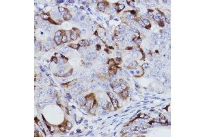 Immunohistochemistry of paraffin-embedded human colon carcinoma using [KO Validated] Cyclin B1 Rabbit mAb (ABIN7266553) at dilution of 1:100 (40x lens). (Cyclin B1 抗体)
