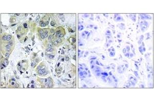 Immunohistochemistry analysis of paraffin-embedded human breast carcinoma tissue, using p70 S6 Kinase (Ab-411) Antibody. (RPS6KB1 抗体  (AA 401-450))