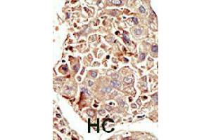 Formalin-fixed and paraffin-embedded human hepatocellular carcinoma tissue reacted with ACVR1 polyclonal antibody  , which was peroxidase-conjugated to the secondary antibody, followed by DAB staining. (ACVR1 抗体  (Internal Region))
