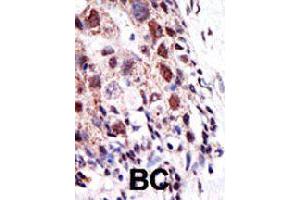 Formalin-fixed and paraffin-embedded human cancer tissue reacted with UBE2S polyclonal antibody  , which was peroxidase-conjugated to the secondary antibody, followed by AEC staining. (UBE2S 抗体  (N-Term))
