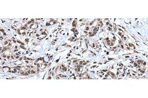 Immunohistochemistry of paraffin-embedded Human gastric cancer tissue using TIA1 Polyclonal Antibody at dilution of 1:30(x200) (TIA1 抗体)