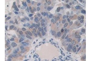 Detection of ITIH1 in Human Breast cancer Tissue using Polyclonal Antibody to Inter Alpha-Globulin Inhibitor H1 (ITIH1) (ITIH1 抗体  (AA 507-819))