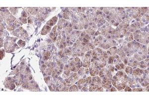 ABIN6273232 at 1/100 staining Human pancreas cancer tissue by IHC-P. (DBN1 抗体  (Internal Region))
