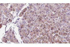 ABIN6273232 at 1/100 staining Human pancreas cancer tissue by IHC-P.