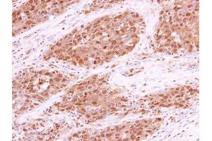 IHC-P Image RPA70 antibody [C1C3] detects RPA70 protein at cytoplasm and nucleus in human lung papillary adenocarcinoma by immunohistochemical analysis. (RPA1 抗体  (C-Term))