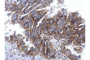 IHC-P Image CCR3 antibody [C2C3], C-term detects CCR3 protein at cytosol on human ovarian carcinoma by immunohistochemical analysis. (CCR3 抗体  (C-Term))