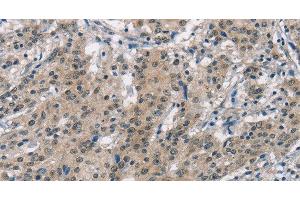 Immunohistochemistry of paraffin-embedded Human gastric cancer using SMAD9 Polyclonal Antibody at dilution of 1:30