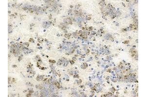ABIN6256537 and ABIN6267228 at 1/100 staining human melanoma by IHC-P. (Aurora A 抗体  (pThr288))