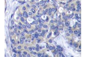 Immunohistochemistry analyzes of ZAP-70 antibody in paraffin-embedded human breast carcinoma tissue. (ZAP70 抗体)