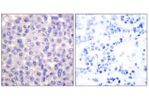 Immunohistochemical analysis of paraffin-embedded human breast carcinoma tissue using TGF beta 3 antibody (ABIN5976517). (TGFB3 抗体  (Internal Region))