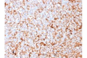 Formalin-fixed, paraffin-embedded human Breast Carcinoma stained with Mammaglobin Recombinant Rabbit Monoclonal Antibody (MGB1/2682R).