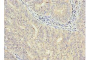 Immunohistochemistry of paraffin-embedded human endometrial cancer using ABIN7175638 at dilution of 1:100 (VHLL 抗体  (AA 1-139))