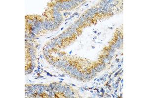 Immunohistochemistry of paraffin-embedded human colon carcinoma using COPA Rabbit mAb (ABIN7266423) at dilution of 1:100 (40x lens). (COPA 抗体)