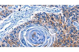 Immunohistochemistry of paraffin-embedded Human esophagus cancer tissue using CLEC2B Polyclonal Antibody at dilution 1:50 (CLEC2B 抗体)