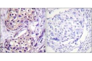 Immunohistochemistry analysis of paraffin-embedded human breast carcinoma tissue, using IKK-beta (Ab-199) Antibody. (IKBKB 抗体  (AA 166-215))