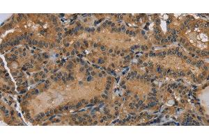 Immunohistochemistry of paraffin-embedded Human thyroid cancer using HSP40-4 Polyclonal Antibody at dilution of 1:60 (HSP40-4 抗体)
