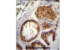 E2EPF Antibody (C-term) (ABIN388858 and ABIN2839160) immunohistochemistry analysis in formalin fixed and paraffin embedded human breast carcinoma followed by peroxidase conjugation of the secondary antibody and DAB staining. (UBE2S 抗体  (C-Term))