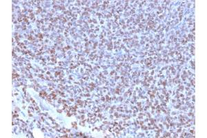Formalin-fixed, paraffin-embedded human Ewing's Sarcoma stained with NKX2. (Nkx2-2 抗体  (AA 1-119))