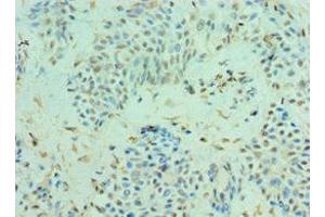 Immunohistochemistry of paraffin-embedded human breast cancer using ABIN7147590 at dilution of 1:100 (CLIC4 抗体  (AA 1-253))