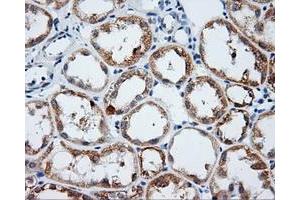 Immunohistochemical staining of paraffin-embedded Carcinoma of liver tissue using anti-LIPG mouse monoclonal antibody. (LIPG 抗体)