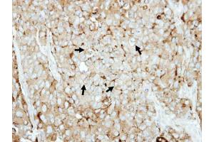IHC-P Image Immunohistochemical analysis of paraffin-embedded BT474 xenograft, using LAMP2, antibody at 1:500 dilution. (LAMP2 抗体)